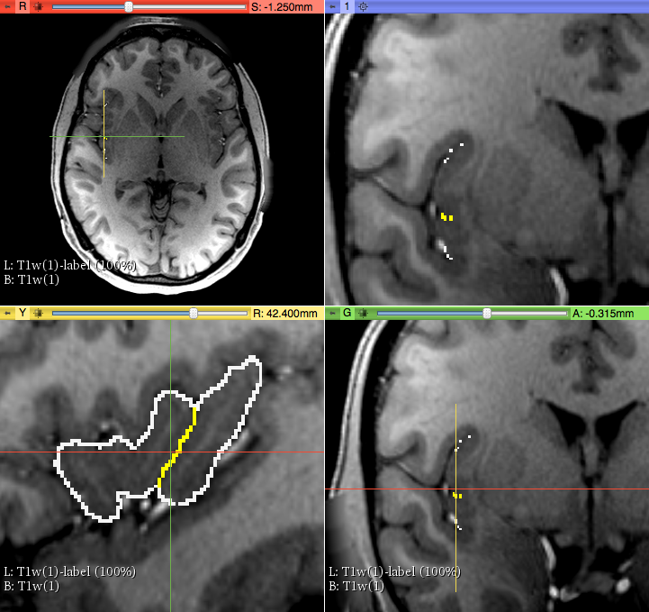 Insula Circular Sulcus and Central Sulcus in the parcellation method of aINS and pINS