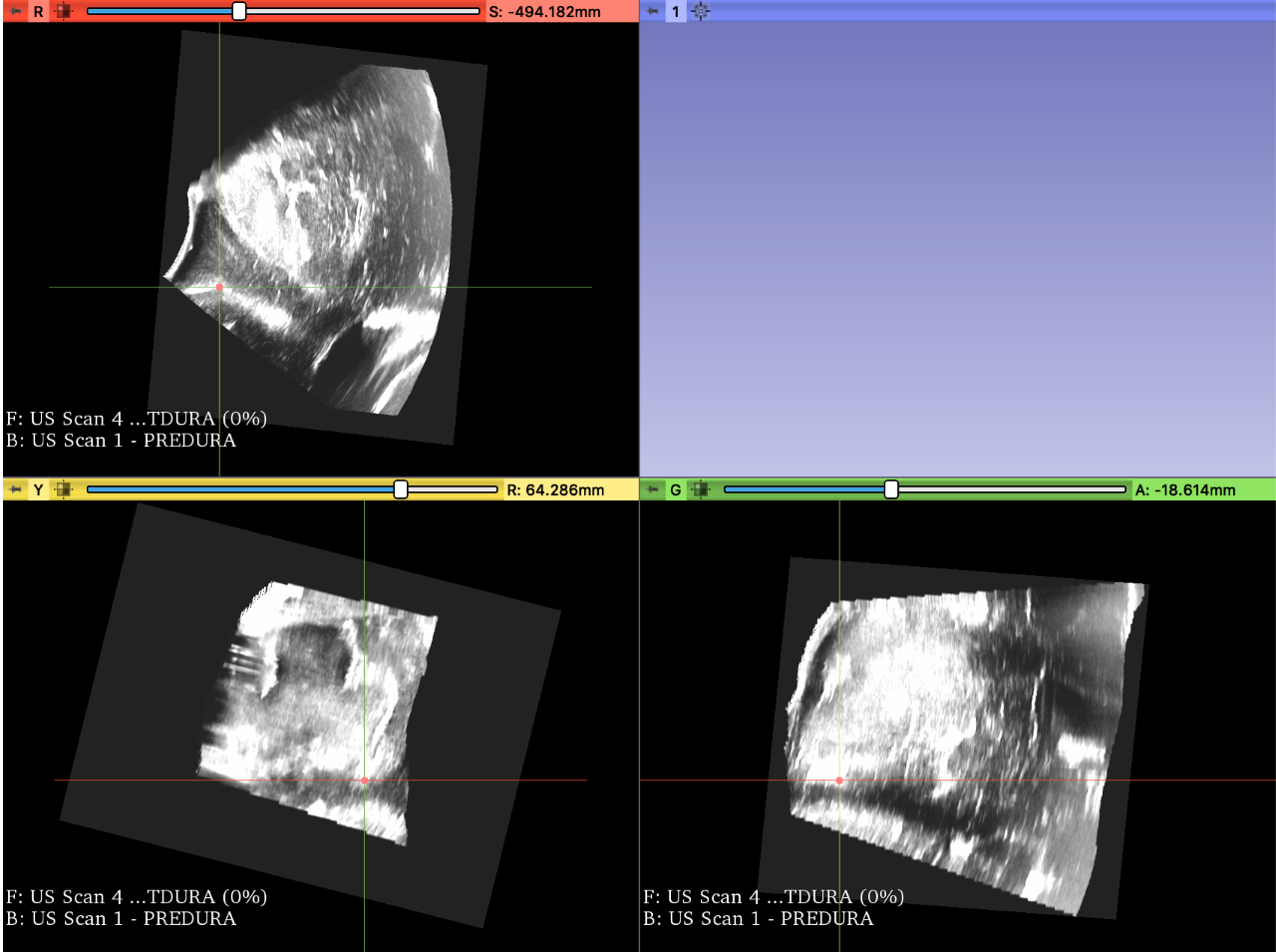 Screenshot of the pre-dura ultrasound with the fiducial on the sulcus