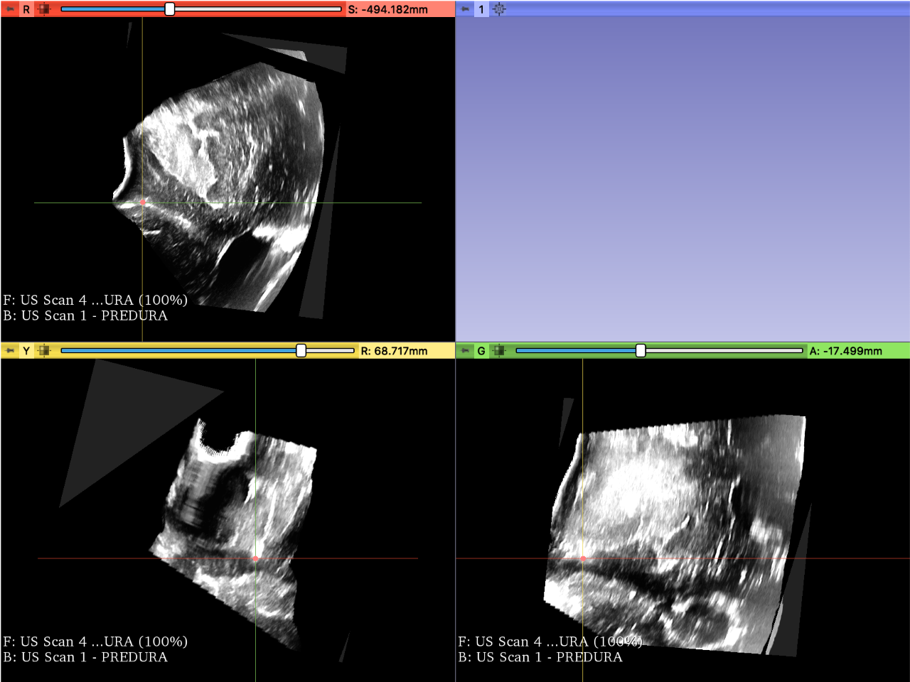Screenshot of the post-dura ultrasound fiducial located on the sulcus