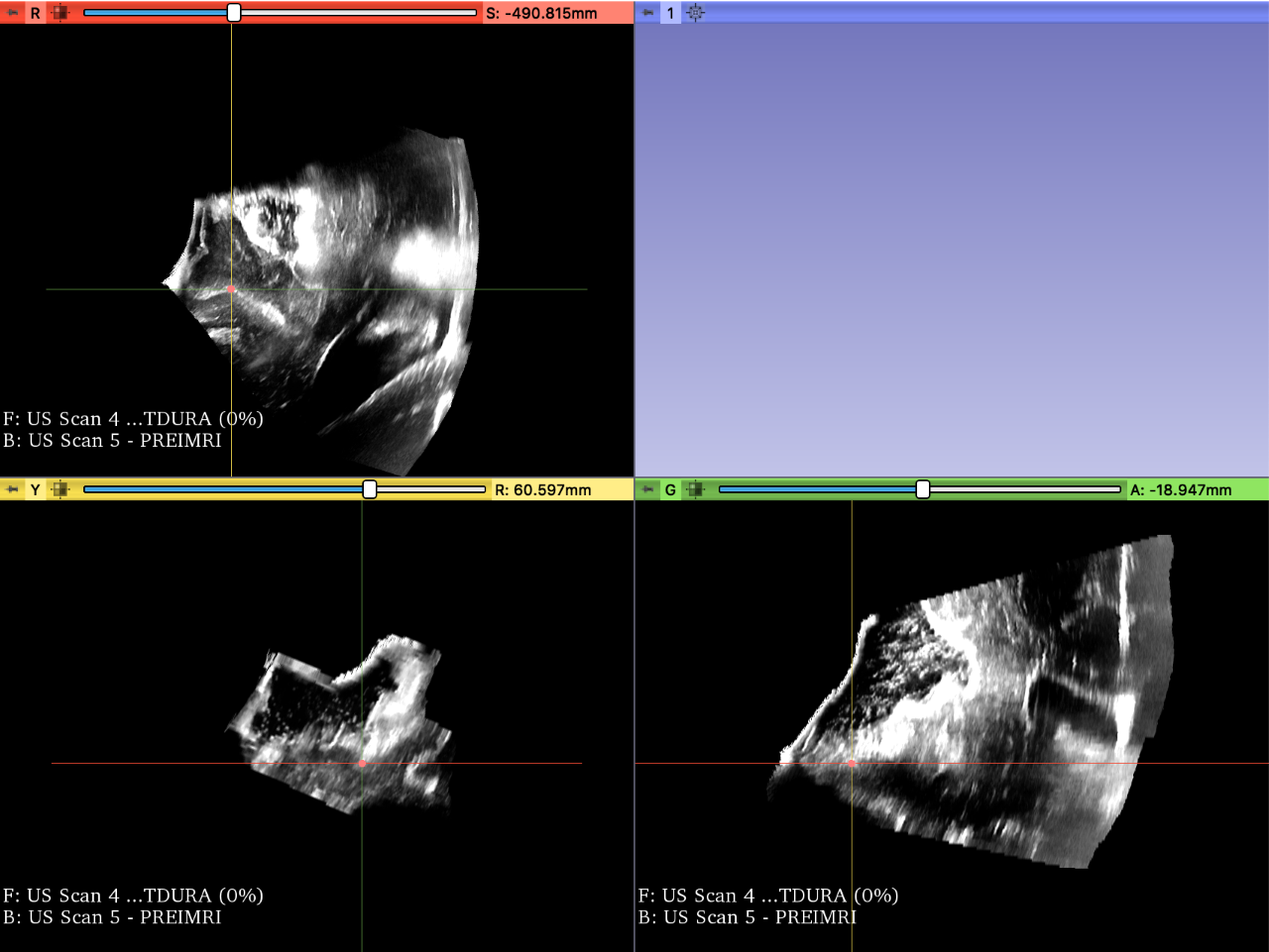 Screenshot of the pre-iMRI of the fiducial located on the sulcus 