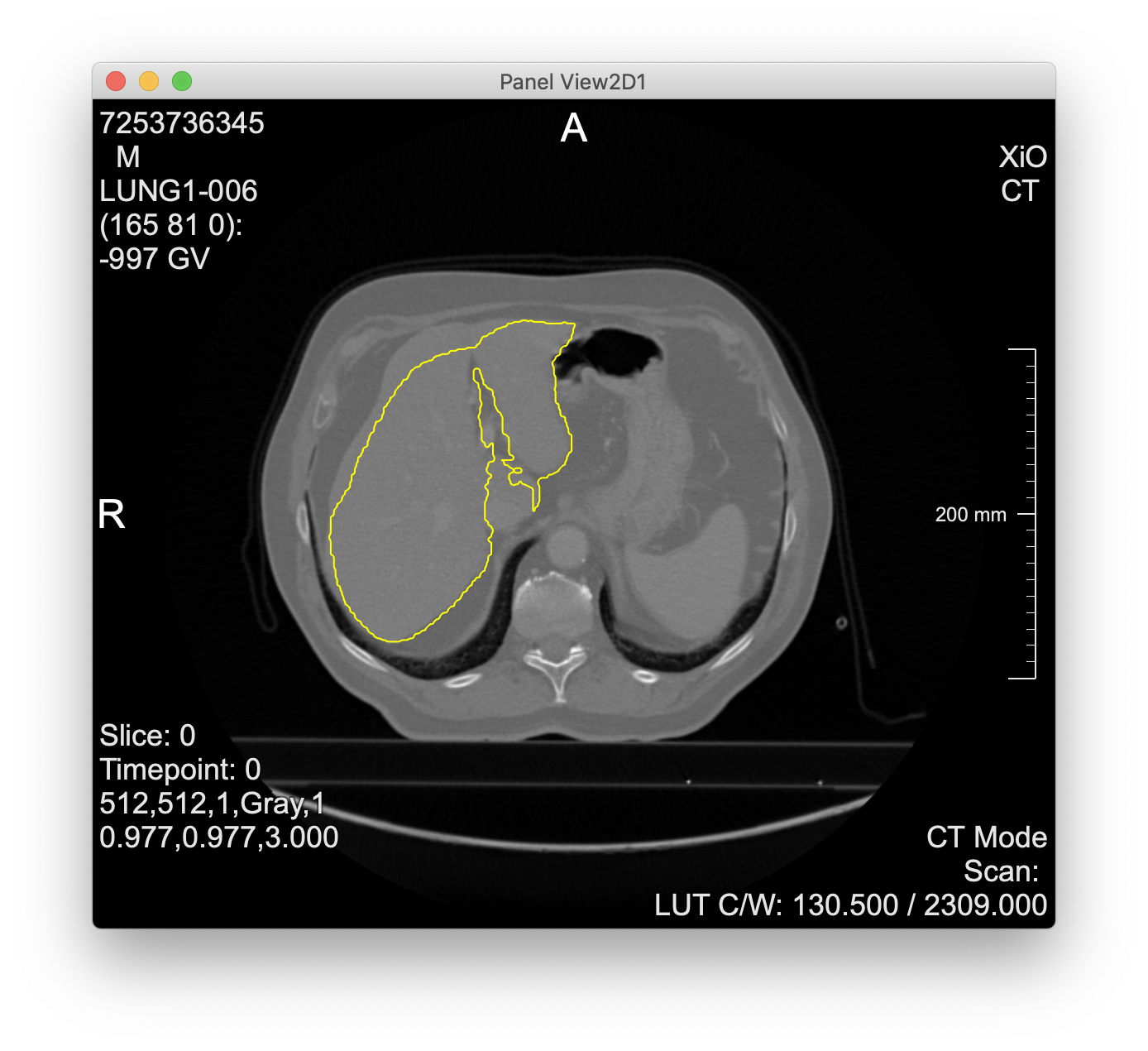MeVisLab viewer with CT slice & liver contour overlay
