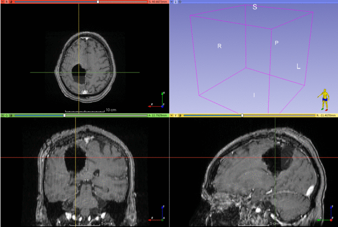 Brain Resection Cavity Segmentation
