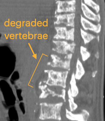 Sample lytic vertebrae