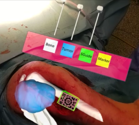 HoloLens 2 in Orthopedic Oncological Surgeries
