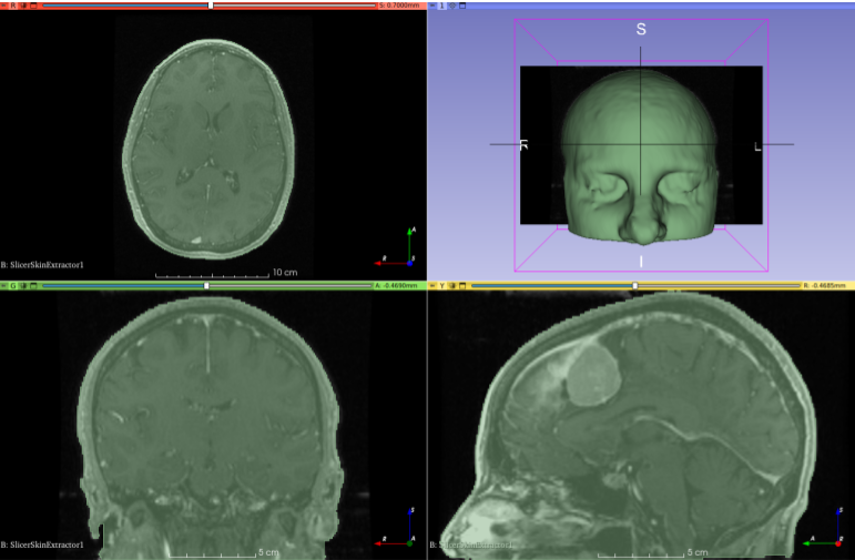 Example of skin surface extraction using Slicer