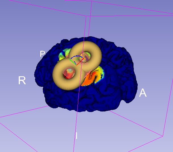 SlicerTMS Module with Efield mapped on brain